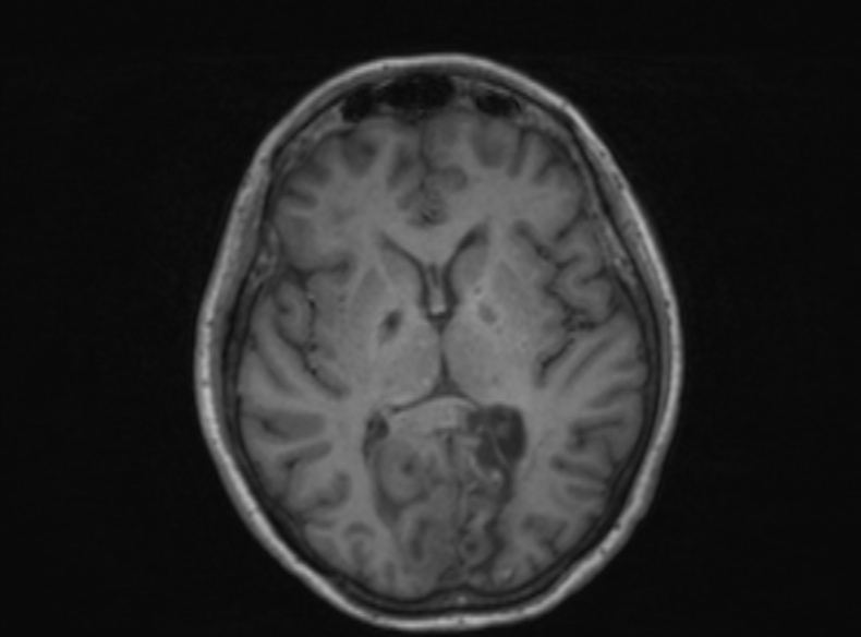 Bilateral PCA territory infarction - different ages (Radiopaedia 46200-51784 Axial T1 233).jpg