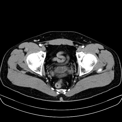 Bilateral accessory renal arteries with mild pelvi-ureteric junction (PUJ) obstruction (Radiopaedia 66357-75596 A 69).jpg
