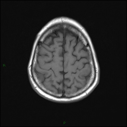 File:Bilateral acute middle cerebral artery territory infarcts (Radiopaedia 77319-89402 Axial T1 20).jpg
