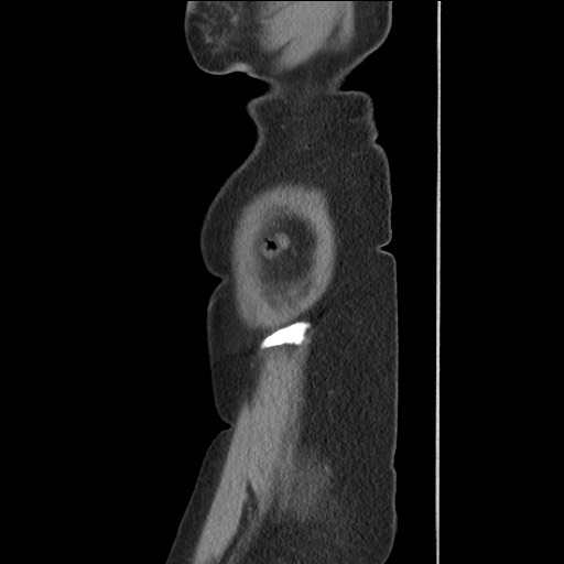 Bilateral adrenal granulocytic sarcomas (chloromas) (Radiopaedia 78375-91007 C 128).jpg