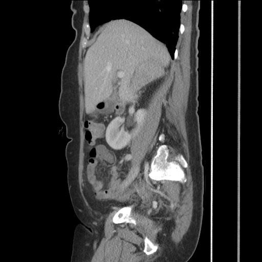 Bilateral adrenal granulocytic sarcomas (chloromas) (Radiopaedia 78375-91007 C 55).jpg