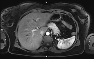 File:Bilateral adrenal myelolipoma (Radiopaedia 63058-71537 Axial T1 C+ fat sat 27).jpg
