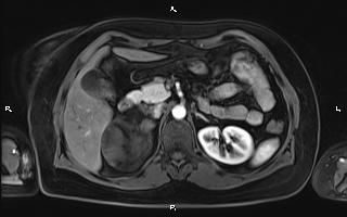 Bilateral adrenal myelolipoma (Radiopaedia 63058-71537 Axial T1 C+ fat sat 40).jpg