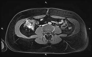 Bilateral adrenal myelolipoma (Radiopaedia 63058-71537 H 71).jpg