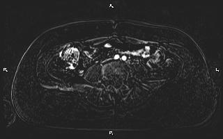 Bilateral adrenal myelolipoma (Radiopaedia 63058-71537 I 74).jpg