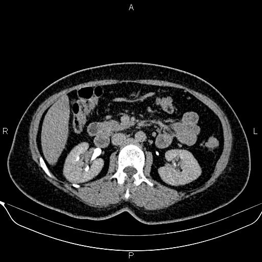 Bilateral benign adrenal adenomas (Radiopaedia 86912-103124 Axial C+ delayed 60).jpg