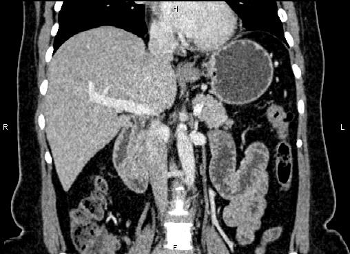 Bilateral benign adrenal adenomas (Radiopaedia 86912-103124 D 29).jpg