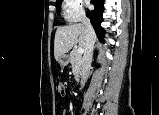 Bilateral benign adrenal adenomas (Radiopaedia 86912-103124 E 43).jpg