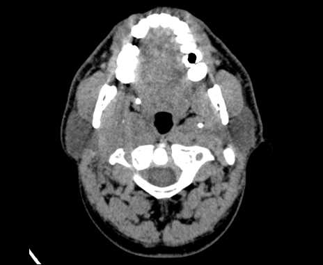 File:Bilateral carotid body tumors (Radiopaedia 61841-69870 Axial non-contrast 24).jpg