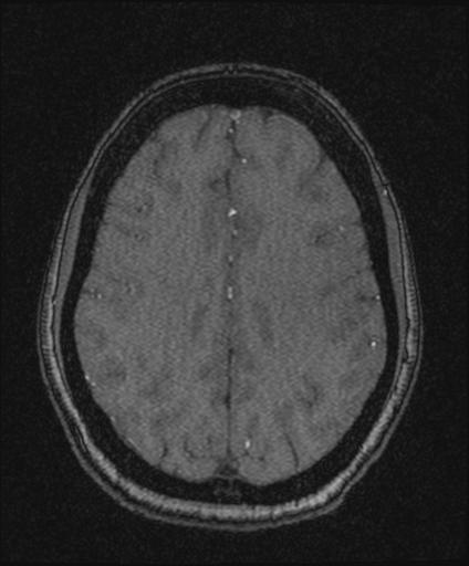 Bilateral carotid body tumors and right glomus jugulare tumor (Radiopaedia 20024-20060 Axial MRA 133).jpg