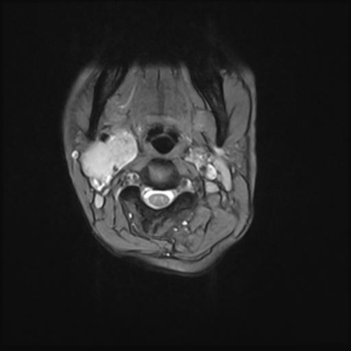 File:Bilateral carotid body tumors and right jugular paraganglioma (Radiopaedia 20024-20060 Axial 72).jpg
