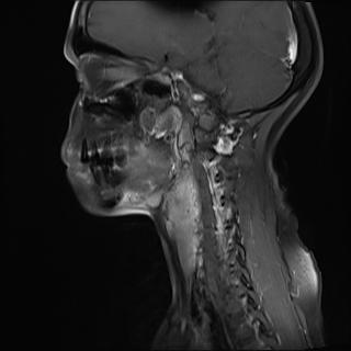 File:Bilateral carotid body tumors and right jugular paraganglioma (Radiopaedia 20024-20060 Sagittal 4).jpg