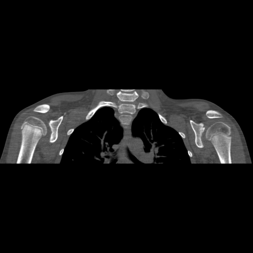 Bilateral chronic posterior shoulder dislocation (Radiopaedia 39213-41452 Coronal bone window 30).jpg
