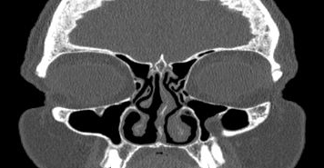File:Bilateral ectopic infraorbital nerves (Radiopaedia 49006-54084 Coronal 50).png