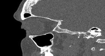 File:Bilateral ectopic infraorbital nerves (Radiopaedia 49006-54084 Sagittal 29).png