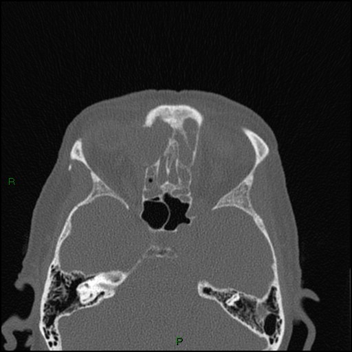 Bilateral frontal mucoceles (Radiopaedia 82352-96454 Axial bone window 130).jpg