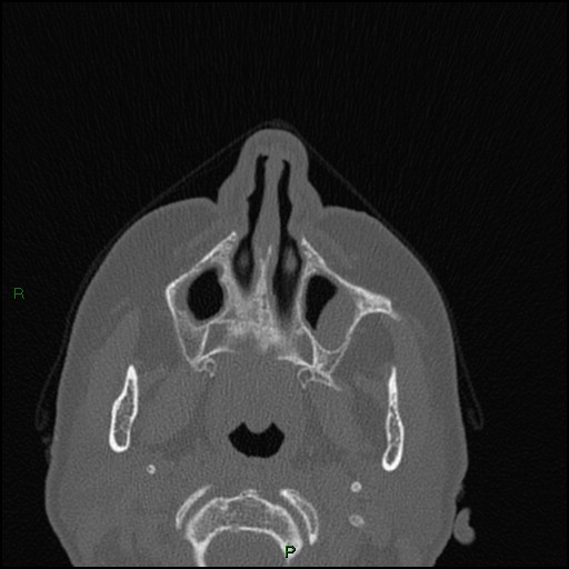 Bilateral frontal mucoceles (Radiopaedia 82352-96454 Axial bone window 223).jpg
