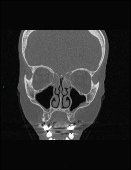 Bilateral frontal mucoceles (Radiopaedia 82352-96454 Coronal 134).jpg
