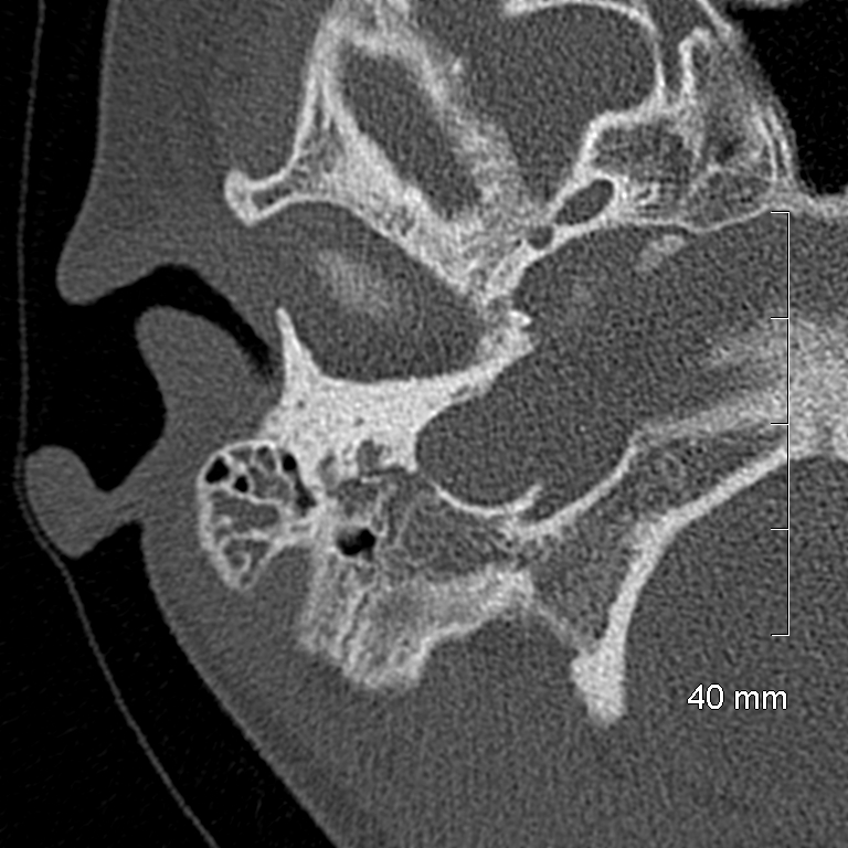 Bilateral grommets (Radiopaedia 47710-52404 Axial bone window 16).jpg