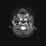 File:Bilateral mesial temporal polymicrogyria (Radiopaedia 76456-88181 Axial DWI 1).jpg