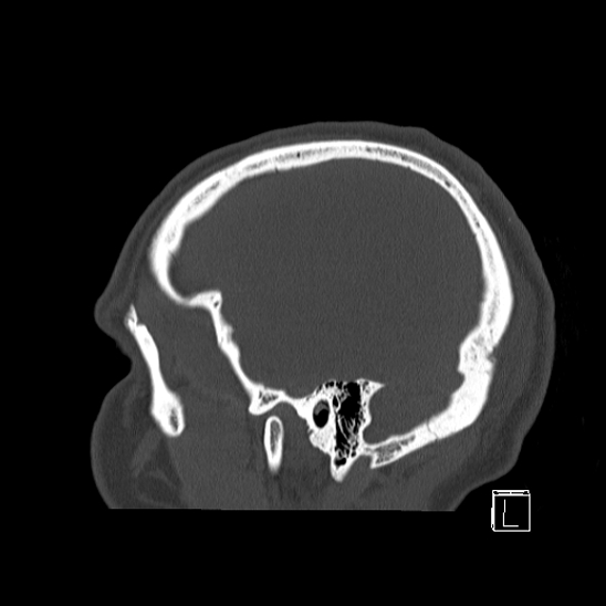 Bilateral occipital condyle fracture (type 2) (Radiopaedia 87675-104089 Sagittal bone window 6).jpg