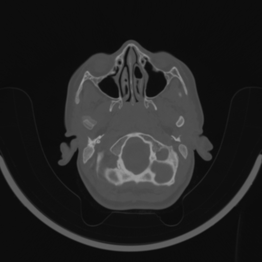 Bilateral otosclerosis (Radiopaedia 57237-64157 C 12).jpg
