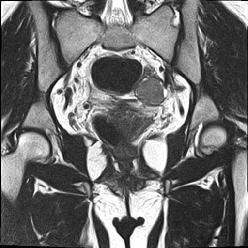 File:Bilateral ovarian endometriomas (Radiopaedia 87085-103347 Coronal T2 13).jpg