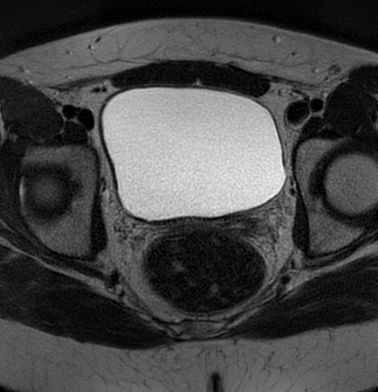 File:Bilateral ovarian fibrothecomas - adolescent (Radiopaedia 86604-102707 Axial T2 31).jpg