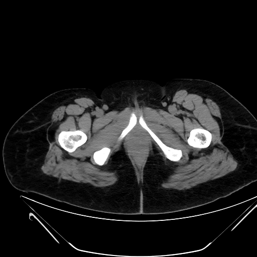 File:Bilateral ovarian mature cystic teratomas (Radiopaedia 79373-92457 Axial non-contrast 101).jpg