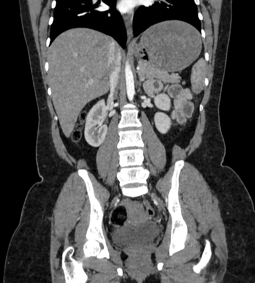 File:Bilateral ovarian mature cystic teratomas (Radiopaedia 79373-92457 B 49).jpg
