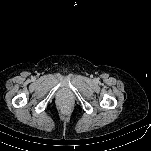 Bilateral ovarian serous cystadenocarcinoma (Radiopaedia 86062-101989 Axial C+ delayed 89).jpg