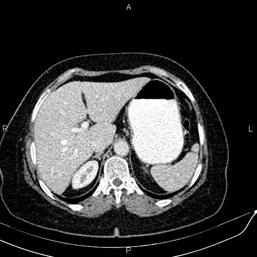 Bilateral ovarian serous cystadenocarcinoma (Radiopaedia 86062-101989 B 24).jpg