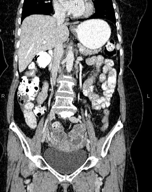 Bilateral ovarian serous cystadenocarcinoma (Radiopaedia 86062-101989 D 21).jpg