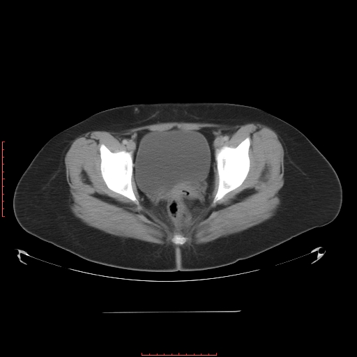File:Bilateral ovarian serous cystadenocarcinoma with right ovarian torsion (Radiopaedia 32640-33611 A 40).jpg