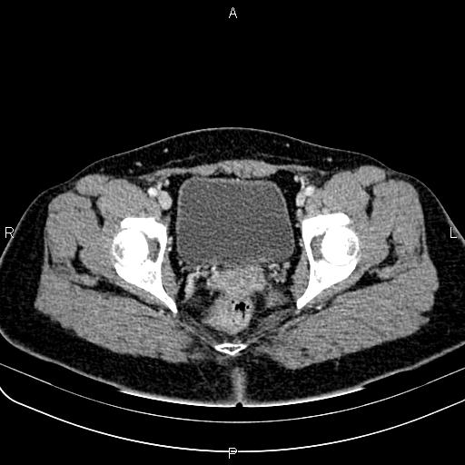 Bilateral ovarian teratoma (Radiopaedia 83131-97503 Axial With contrast 63).jpg