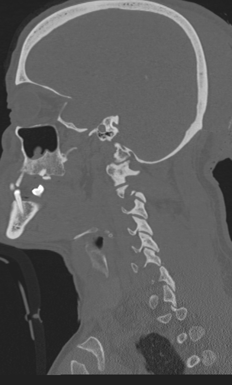 Bilateral perched facet joint (Radiopaedia 63149-71669 Sagittal bone window 58).jpg