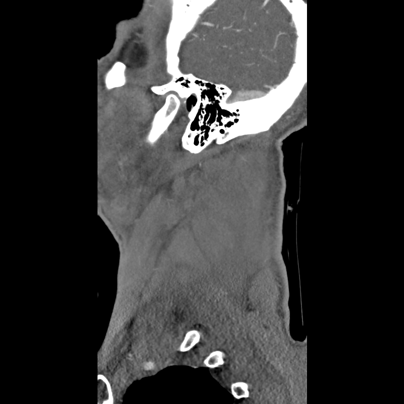 Bilateral perched facets with cord injury (Radiopaedia 45587-49713 B 51).jpg