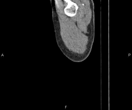 Bilateral pulmonary AVM (Radiopaedia 83134-97505 D 2).jpg