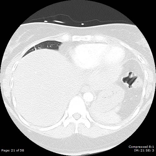 Bilateral pulmonary emboli with Hampton hump sign (Radiopaedia 54070-60246 Axial lung window 21).jpg