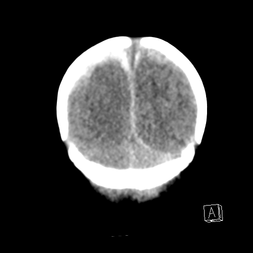 File:Bilateral subdural hemorrhage and parietal skull fracture (Radiopaedia 26058-26192 Coronal non-contrast 25).png