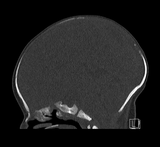 Bilateral subdural hemorrhage and parietal skull fracture (Radiopaedia 26058-26192 Sagittal bone window 46).png