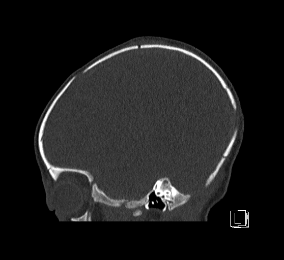 Bilateral subdural hemorrhage and parietal skull fracture (Radiopaedia 26058-26192 Sagittal bone window 74).png