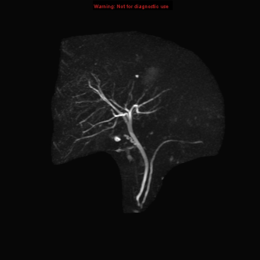 File:Biliary tree anatomical variant - biliary trifurcation (Radiopaedia 12531-12750 Coronal 3D MRCP 5).jpg