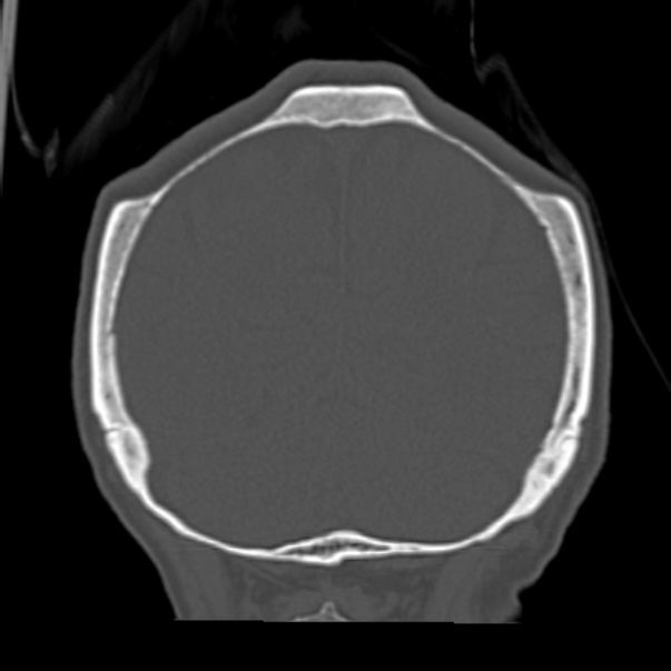 Biparietal osteodystrophy (Radiopaedia 46109-50463 Coronal bone window 85).jpg