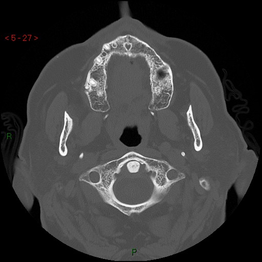 File:Bisphosphonate-related osteonecrosis of the jaw (Radiopaedia 54147-60329 Axial bone window 21).jpg