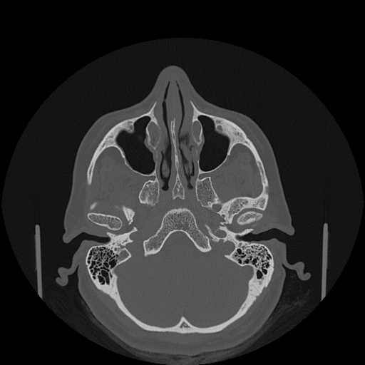 File:Bisphosphonate-related osteonecrosis of the jaw (Radiopaedia 71324-81642 Axial bone window 151).jpg
