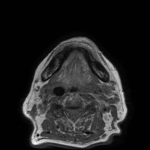 Bisphosphonate-related osteonecrosis of the maxilla (Radiopaedia 51367-57101 Axial T1 7).jpg