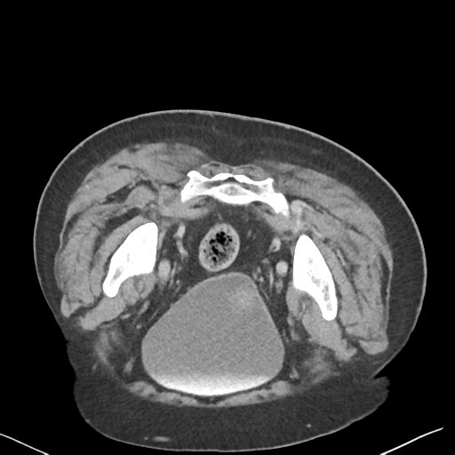File:Bladder papillary urothelial carcinoma (Radiopaedia 48119-52951 Axial C+ delayed 50).png