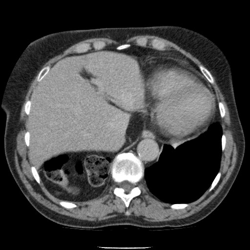 Bladder tumor detected on trauma CT (Radiopaedia 51809-57609 C 24).jpg