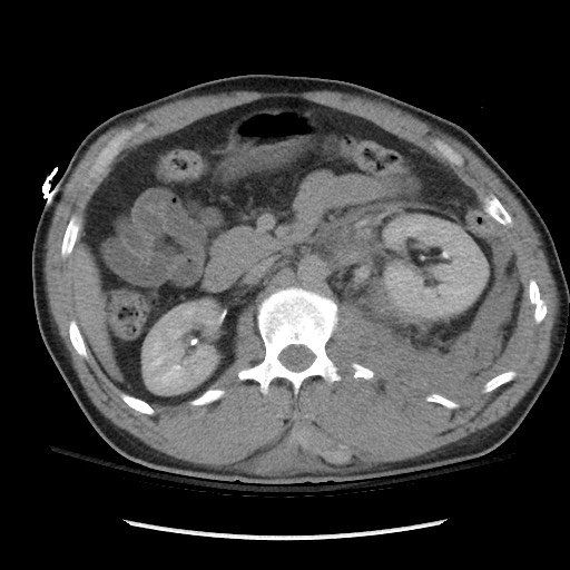 Blunt abdominal trauma with solid organ and musculoskelatal injury with active extravasation (Radiopaedia 68364-77895 Axial C+ delayed 56).jpg